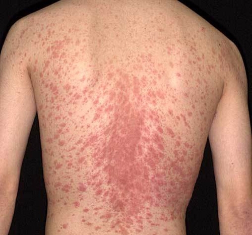Vẩy nến là gì? Nguyên nhân, triệu chứng, dấu hiệu